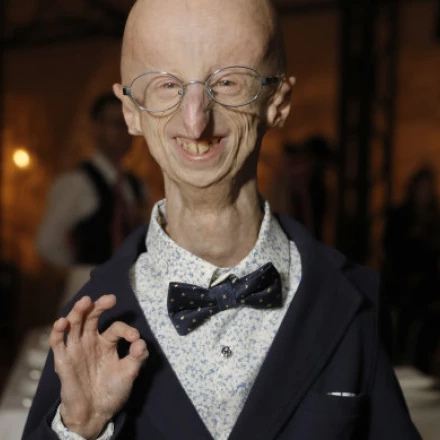 Imagen relacionada de sammy basso fallece progeria